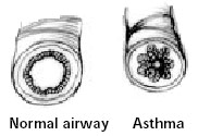 Normal Airway vs Asthma Airway
