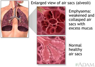 Enlarged view of air sacs (alveoli) - Emphysema: weakened and collapsed air sacs with excess mucus vs. normal healthy air sacs
